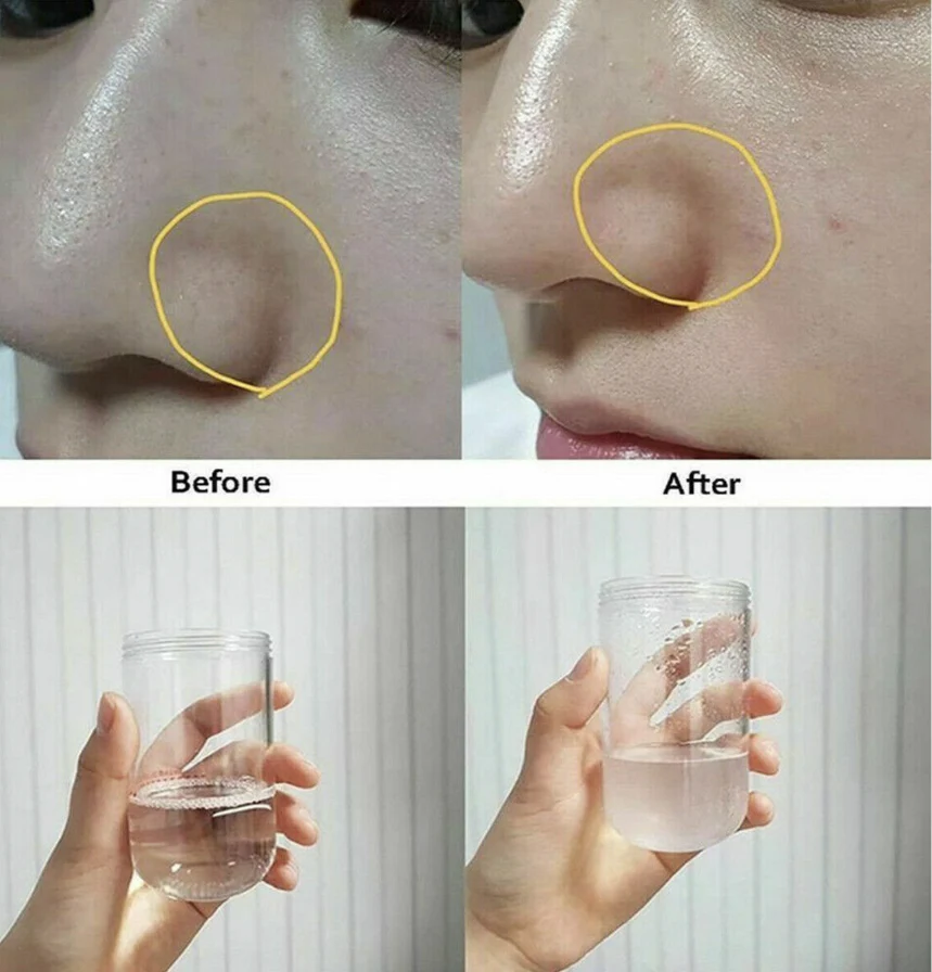 Hidrafacial Aqua Peeling - Imagen 7