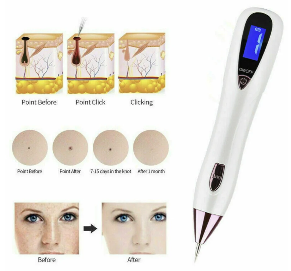 Plasma Pen Mole - Imagen 7